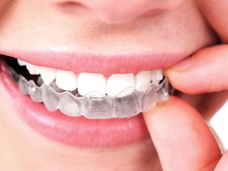 Which option to choose: Braces or transparent aligners?